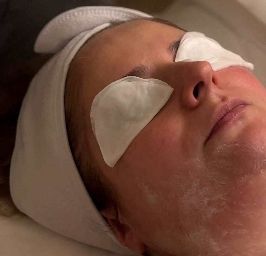 Chemical Peels
